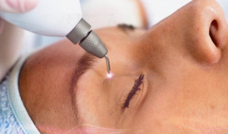 technology.plasmaJet.title